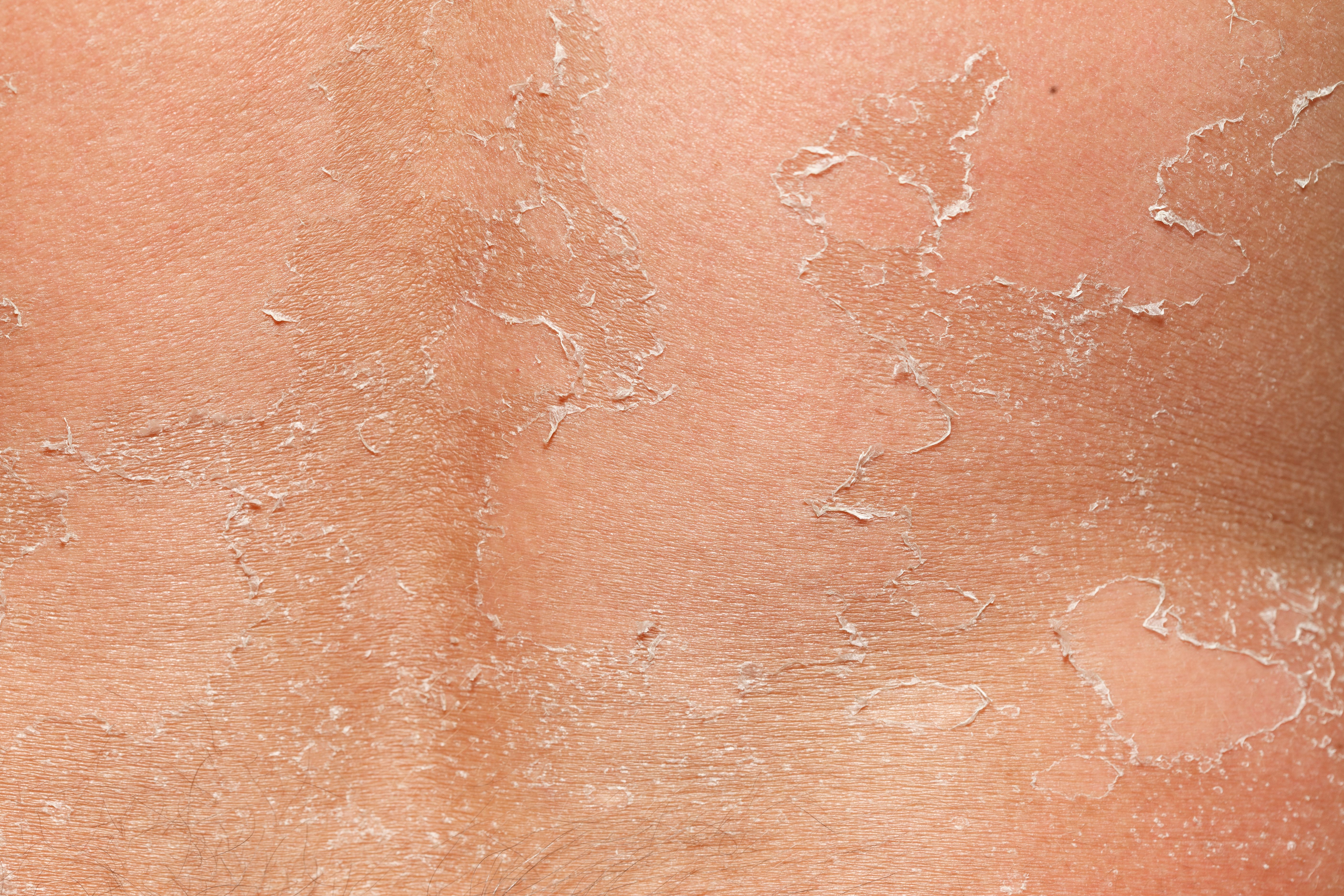 Human skin debris